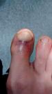 Running/Road/Damage/Right foot big toe